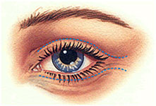 eyelid surgery scars